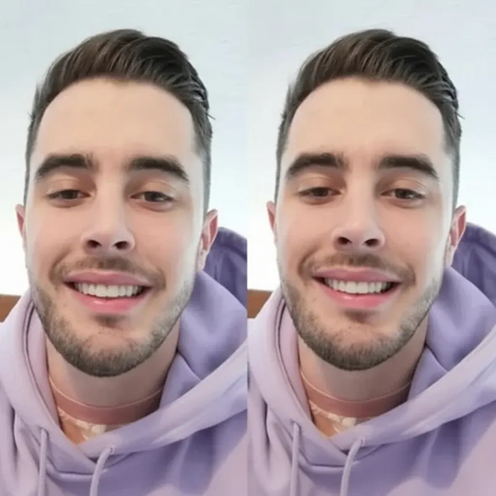 Budget-Friendly Removable Smile Veneers with Natural Look