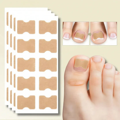 Ingrown Toenail Correction Patches Treatment