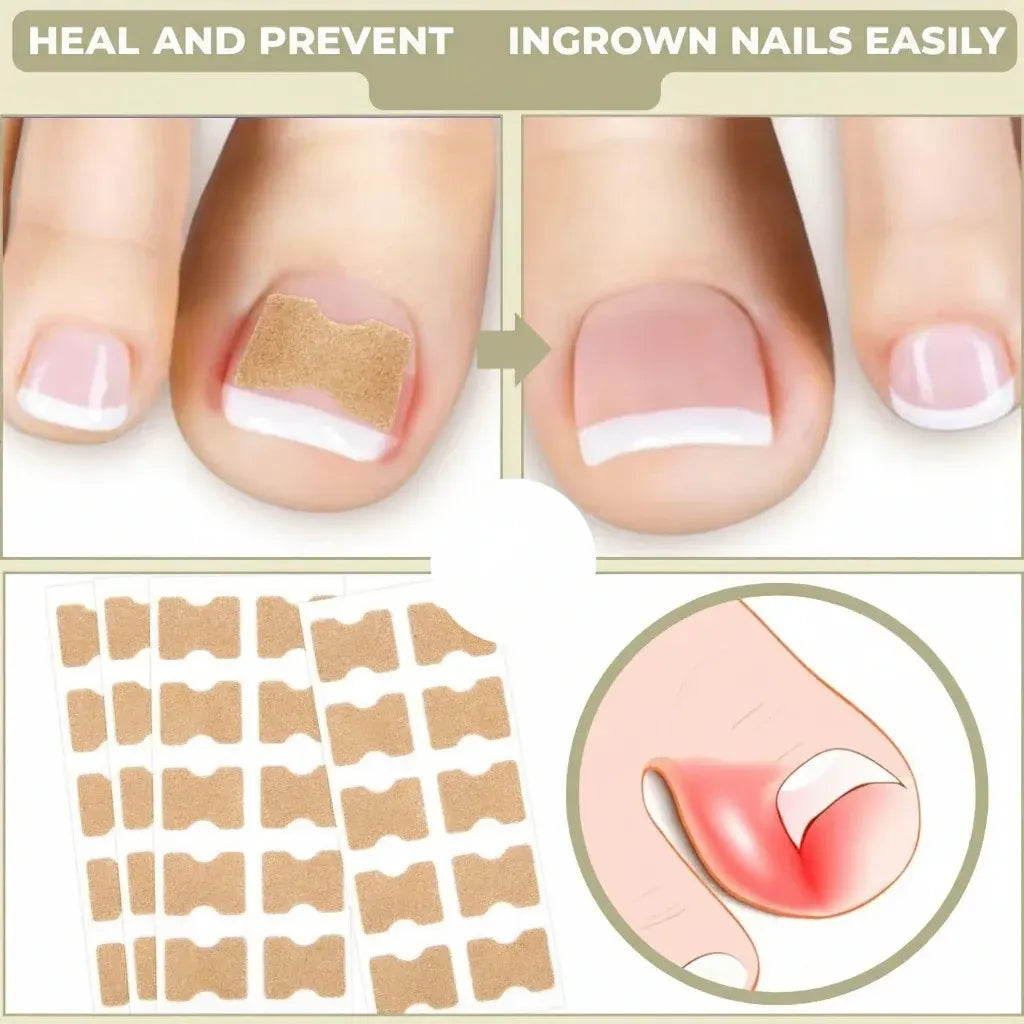 Ingrown Toenail Correction Patches Treatment