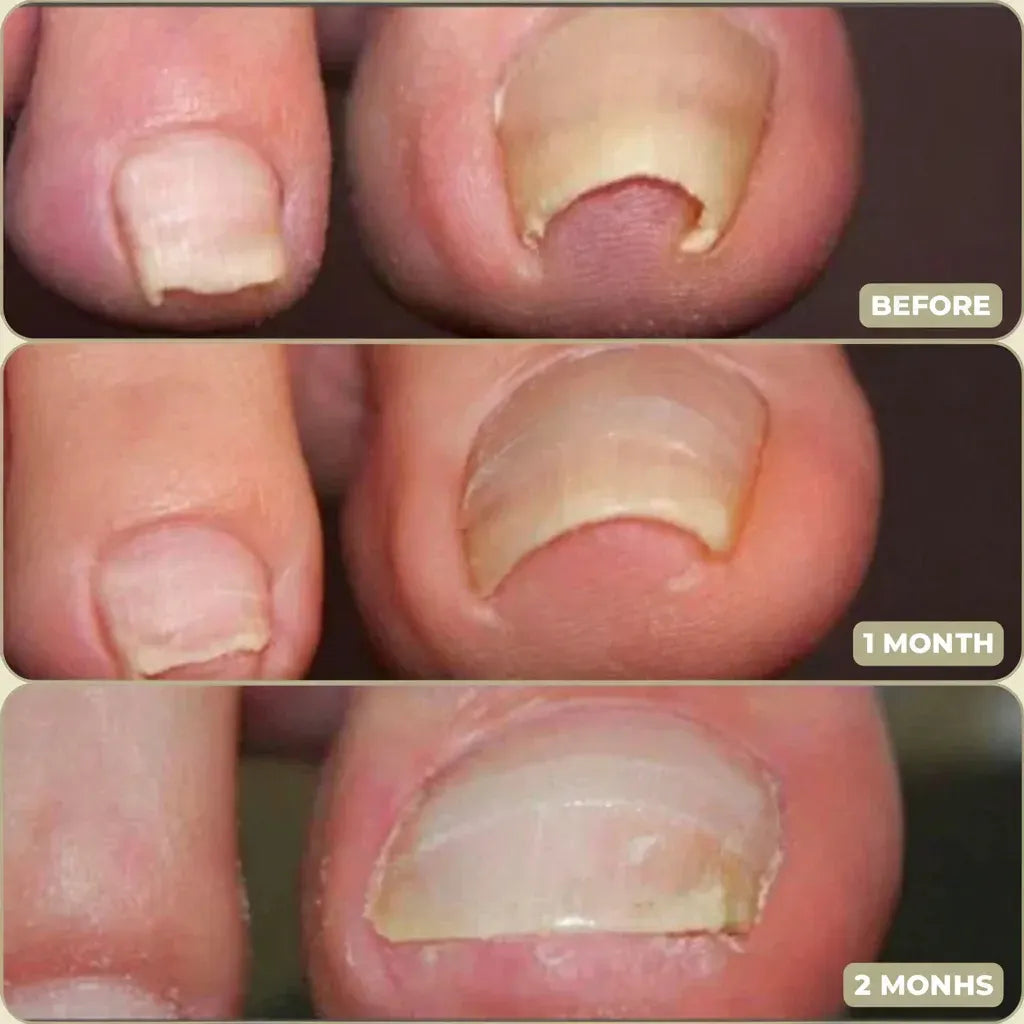 Ingrown Toenail Correction Patches Treatment
