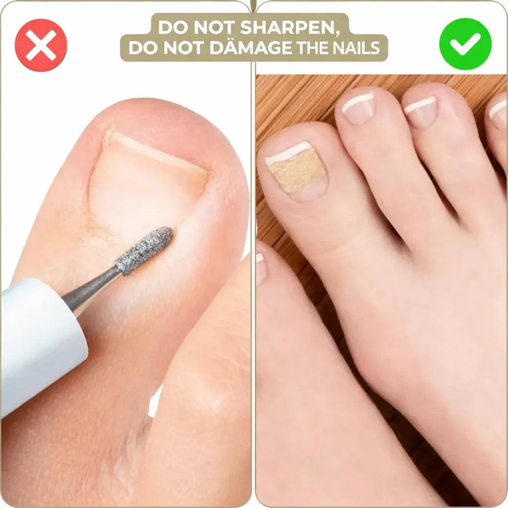 Ingrown Toenail Correction Patches Treatment